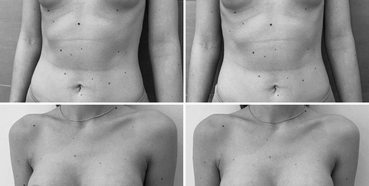 Mellplasztika kerek mellimplantátum implantátum