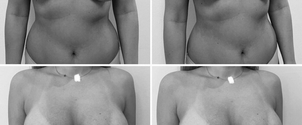 Mellfelvarrás 325 köbcentis implantátummal kombinálva