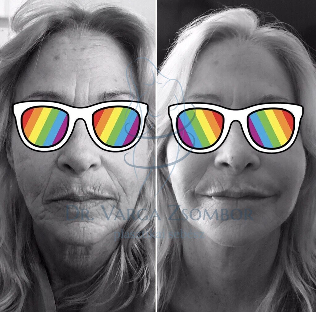 Arcplasztika előtte-utána