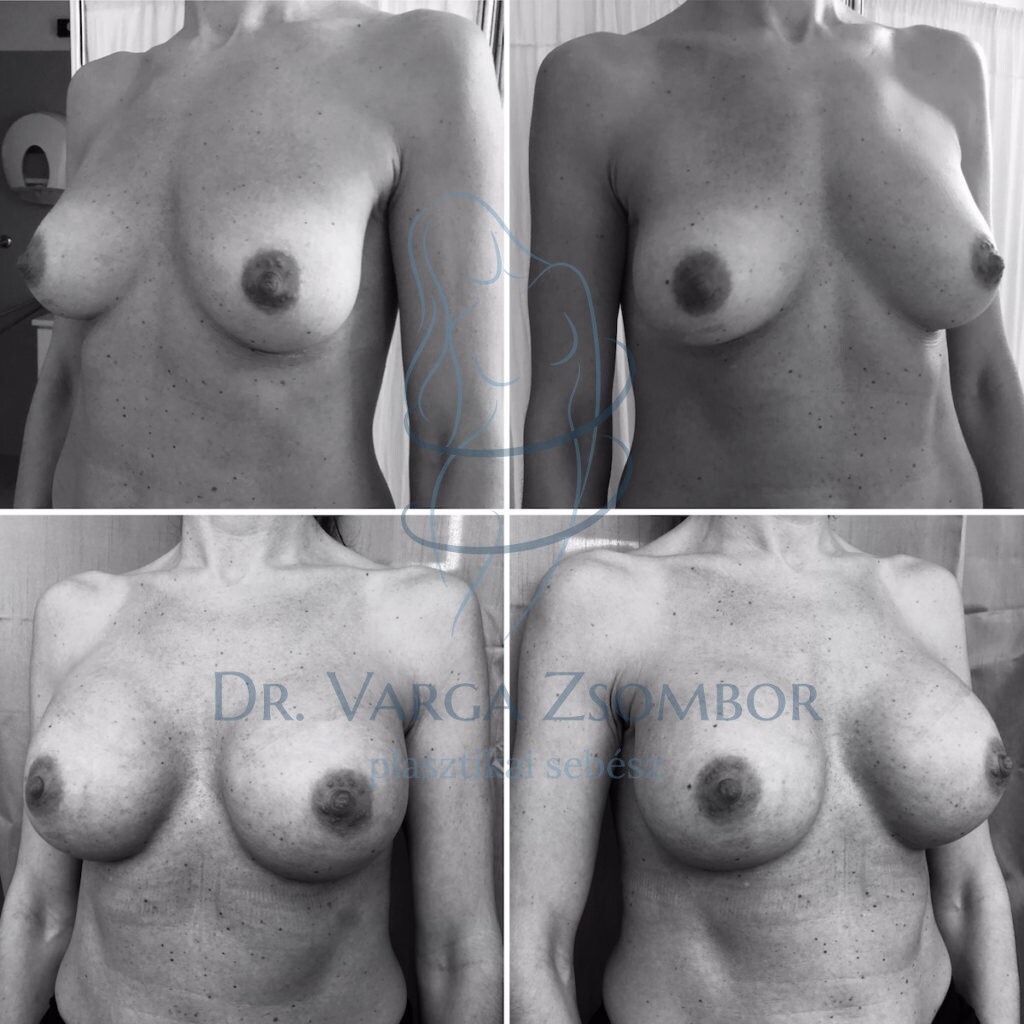 mellimplantátum csere előtte utána