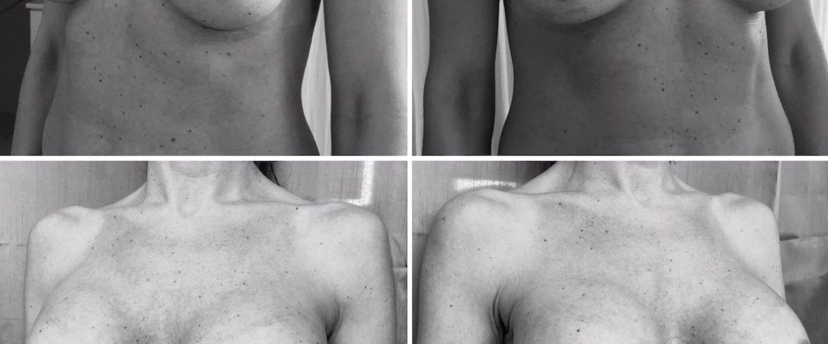 mellimplantátum csere előtte utána