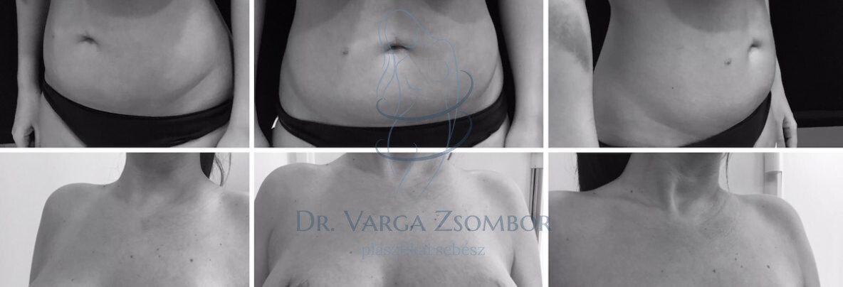 Mellfelvarrás előtte utána kicsi