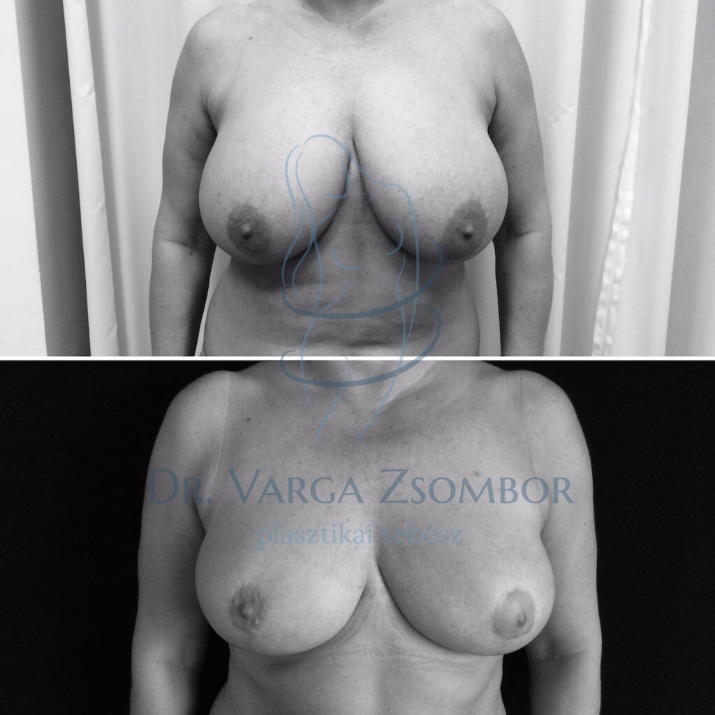 mellkisebbítés előtte utána képpel
