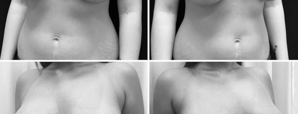 mellimplantátum és mellfelvarrás egyszerre