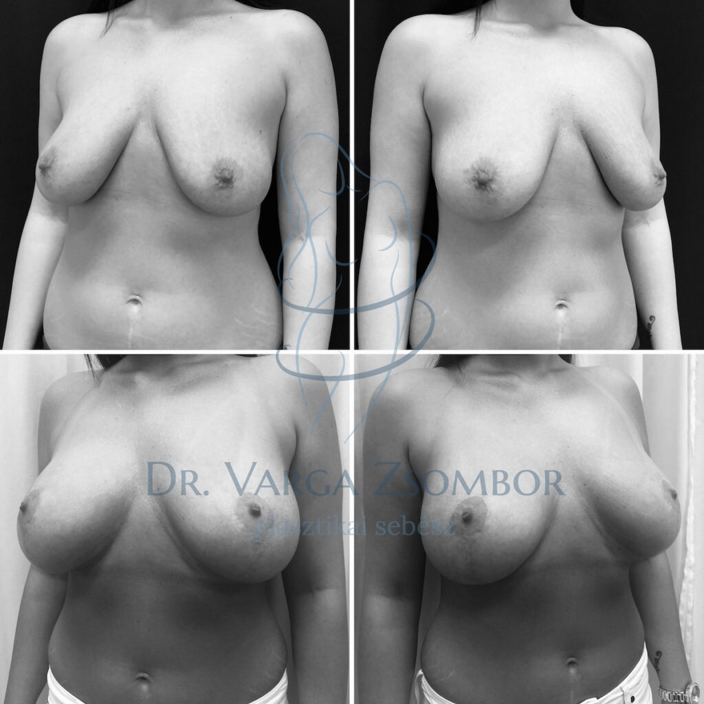 mellimplantátum és mellfelvarrás egyszerre