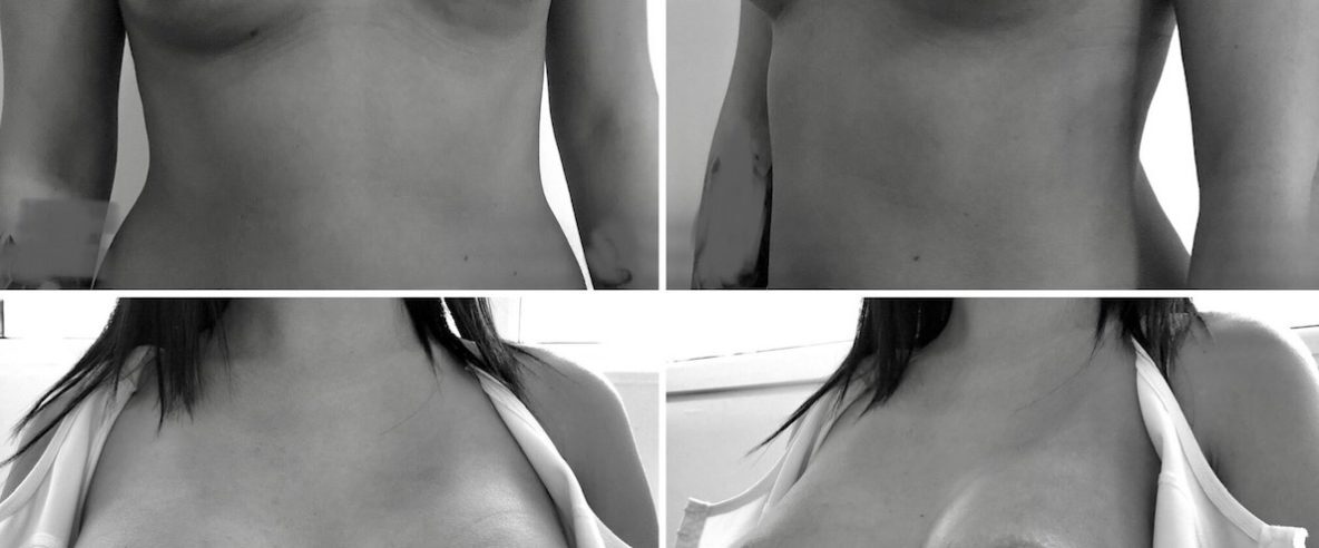 mellnagyobbítás előtte utána