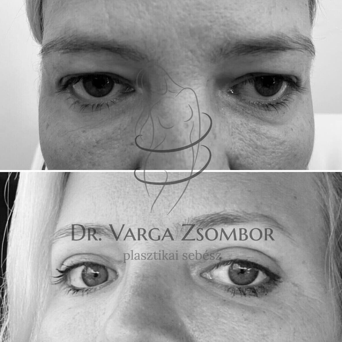 felső szemhéjplasztika előtte-utána