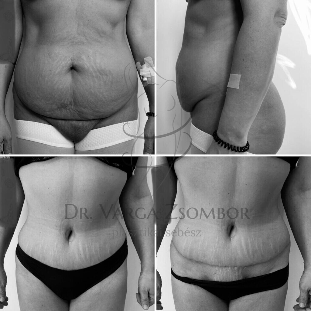 teljes hasplasztika hege