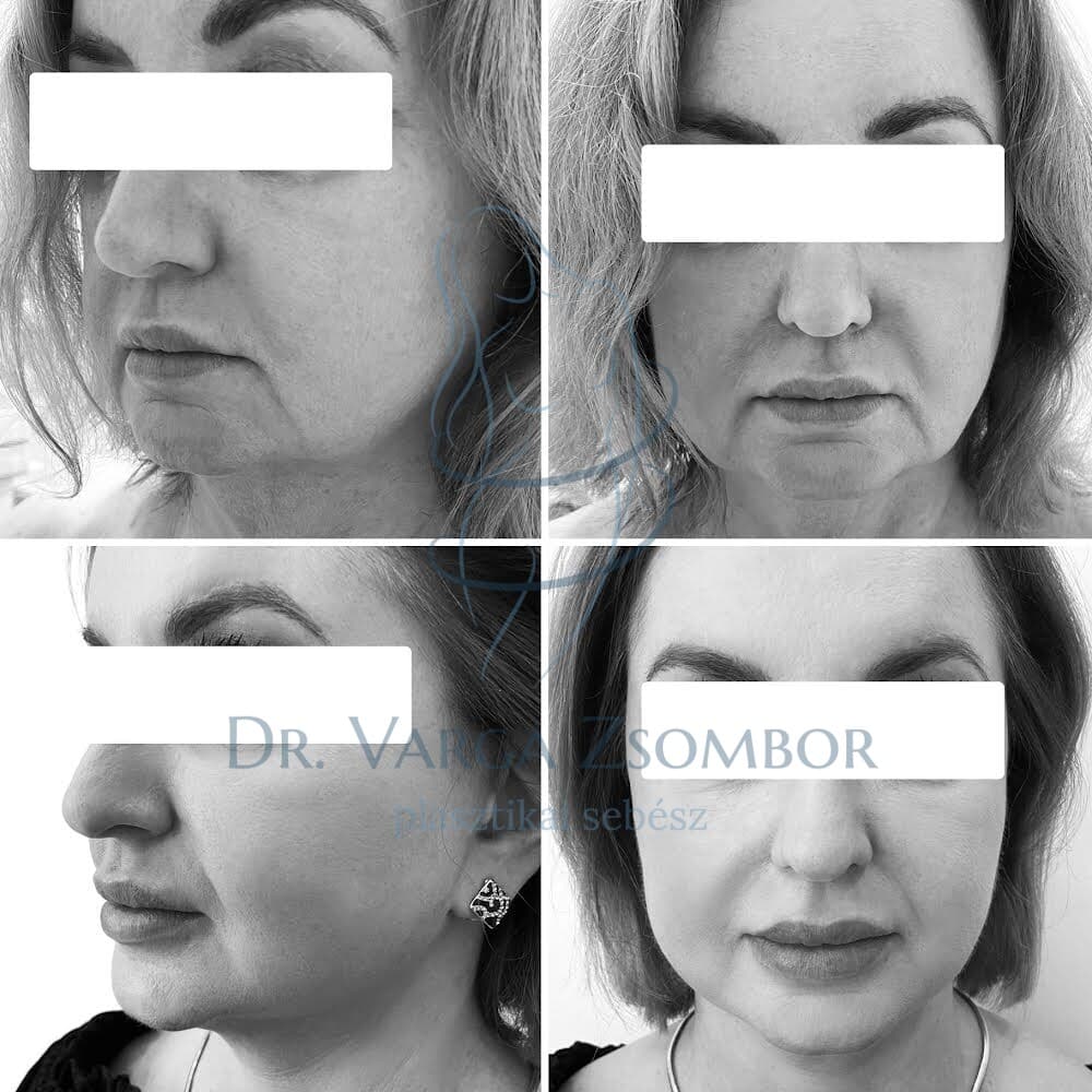 arcplasztika előtte utána