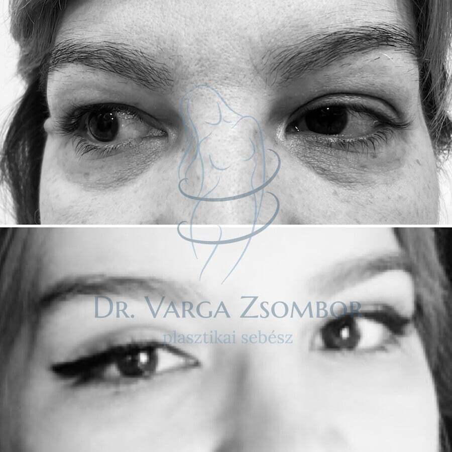 felső szemhéjplasztika