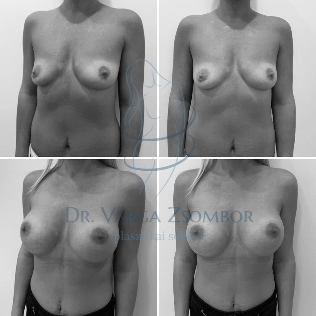 mell aszimmetria implantátum