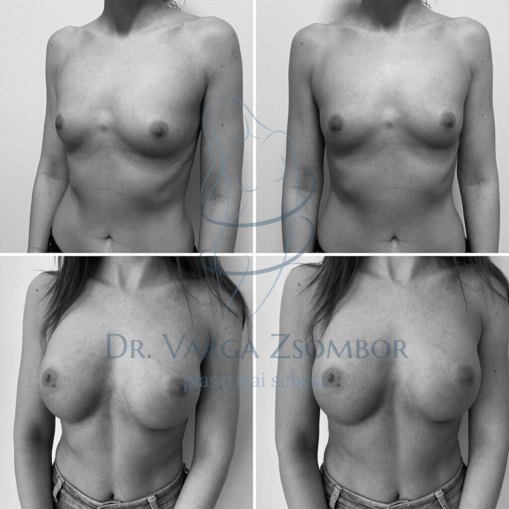 kerek 250cc mellimplantátum