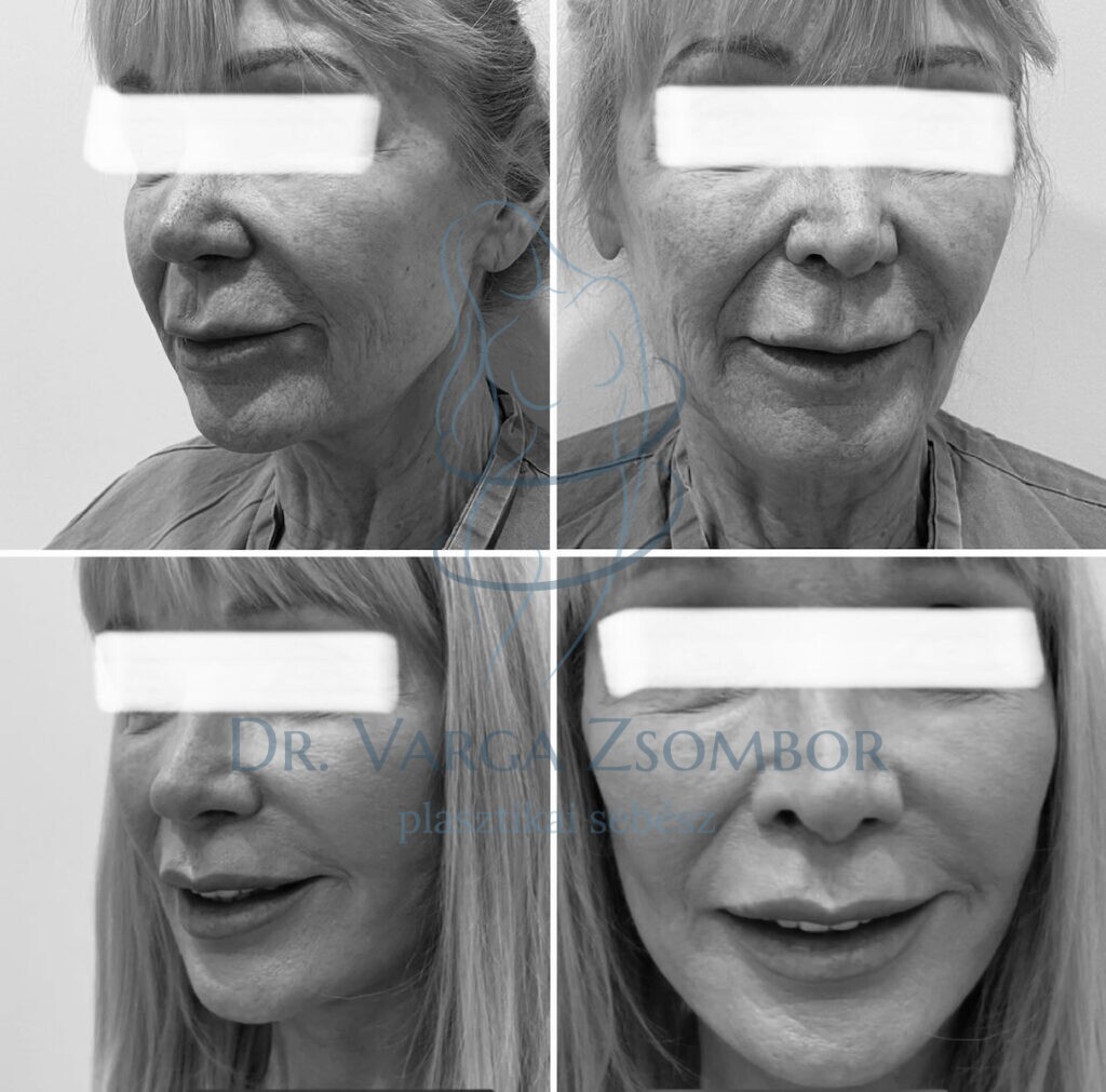 arcplasztika és nyakplasztika