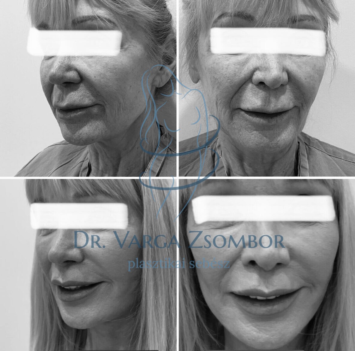 arcplasztika és nyakplasztika