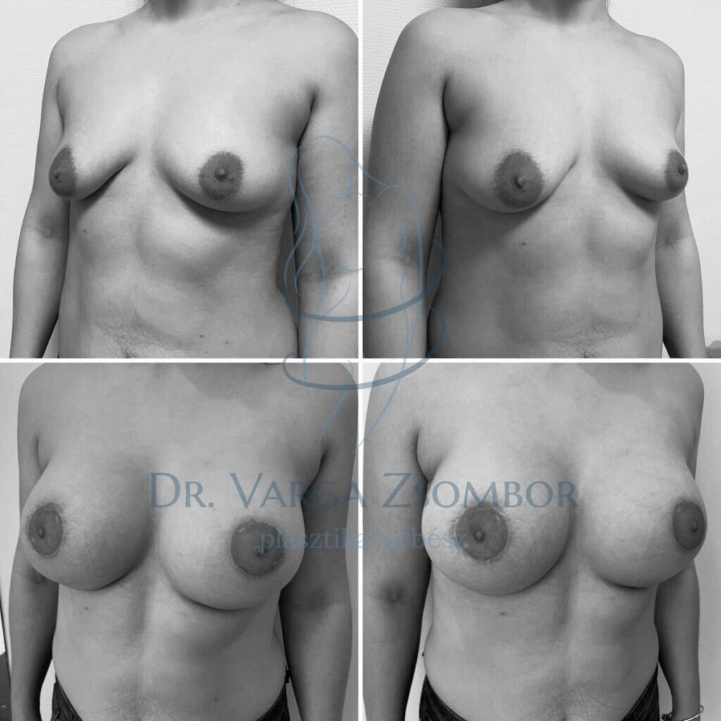 Tubuláris mell, enyhe aszimmetriával