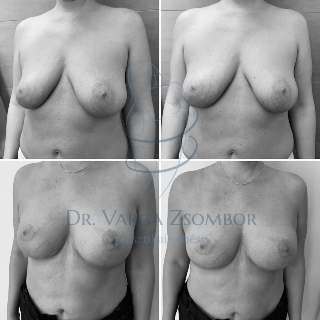 Mellfelvarrás után