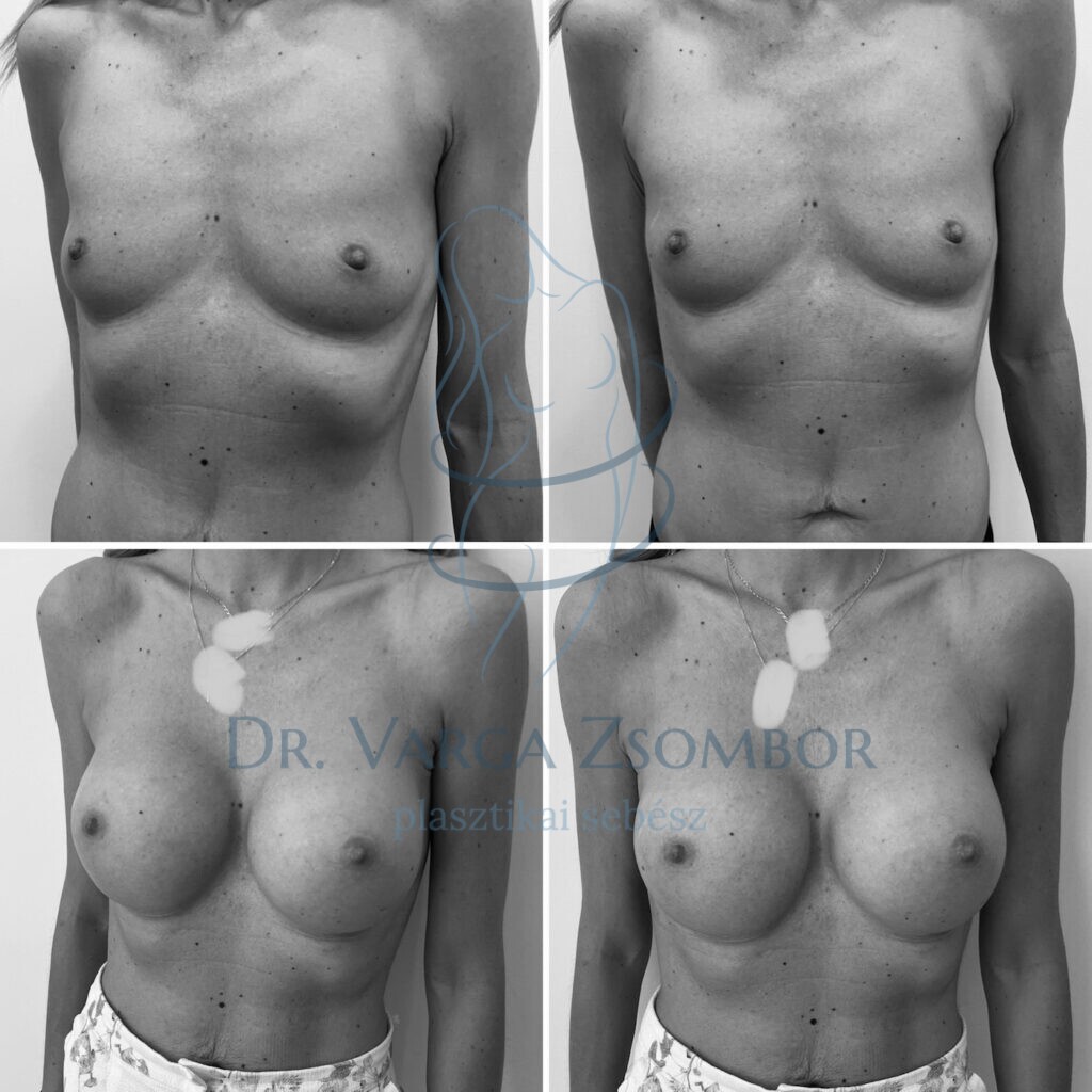 mellplasztika után