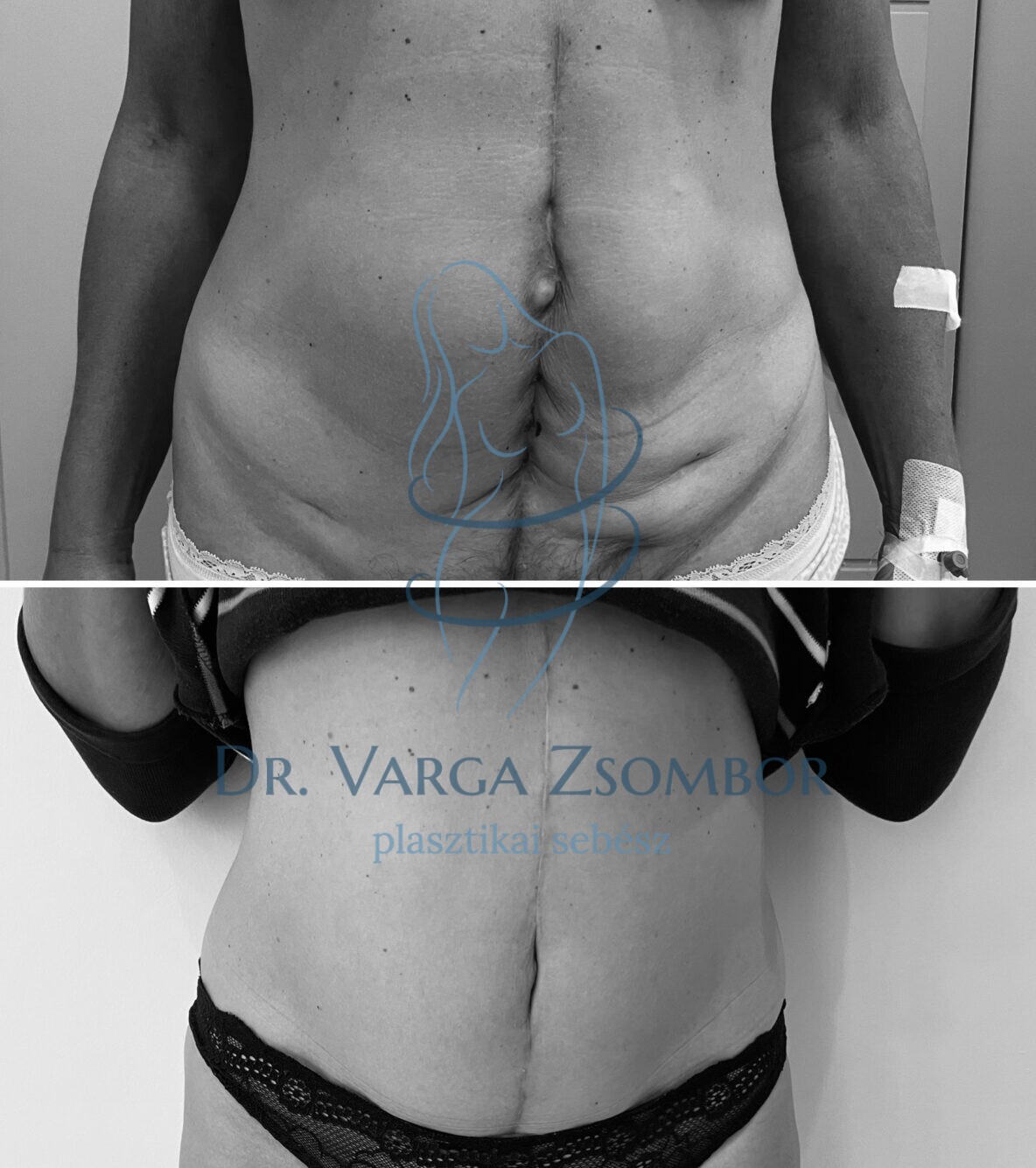 Hasplasztika hasfal helyreállítás