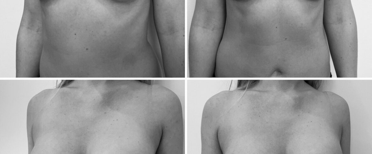 Kerek mellimplantátum