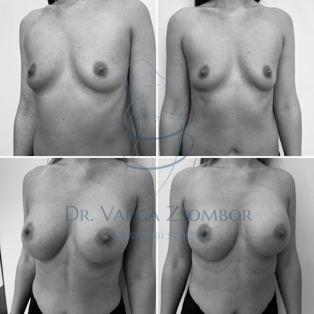 Kerek mellimplantátum