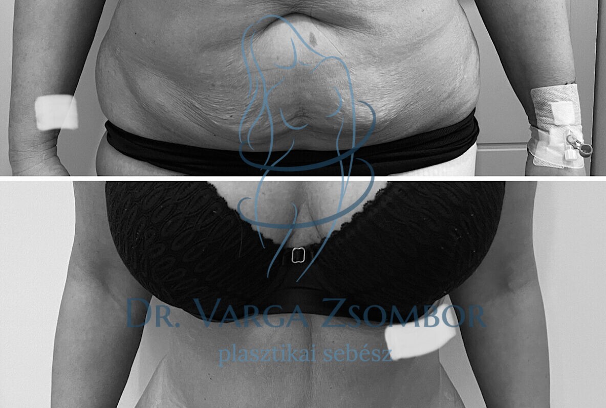 Teljes hasplasztika zsírleszívással