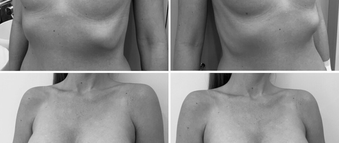 Középmagas mellimplantátum