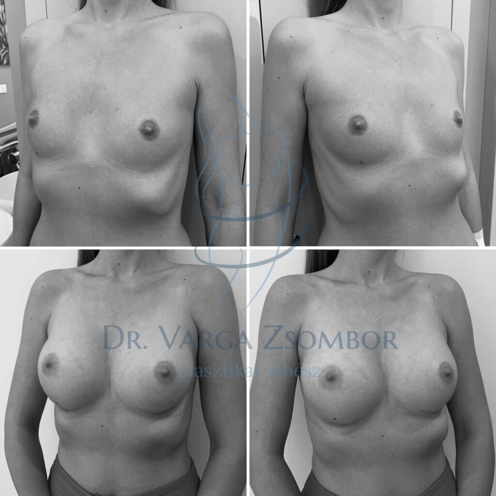 középmagas mellimplantátum
