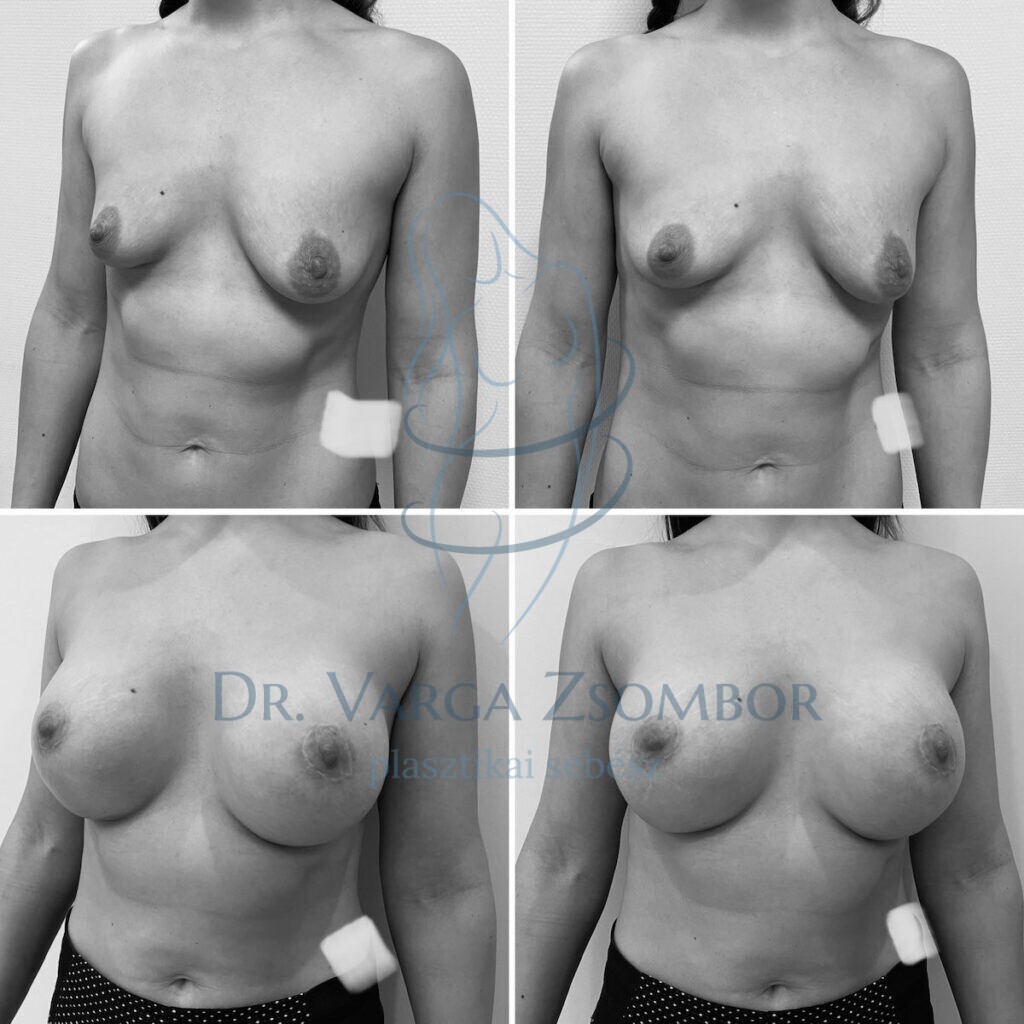 mellnagyobbítás képek