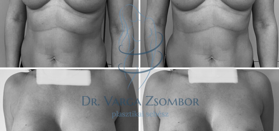 Mellplasztika középmagas mellimplantátum