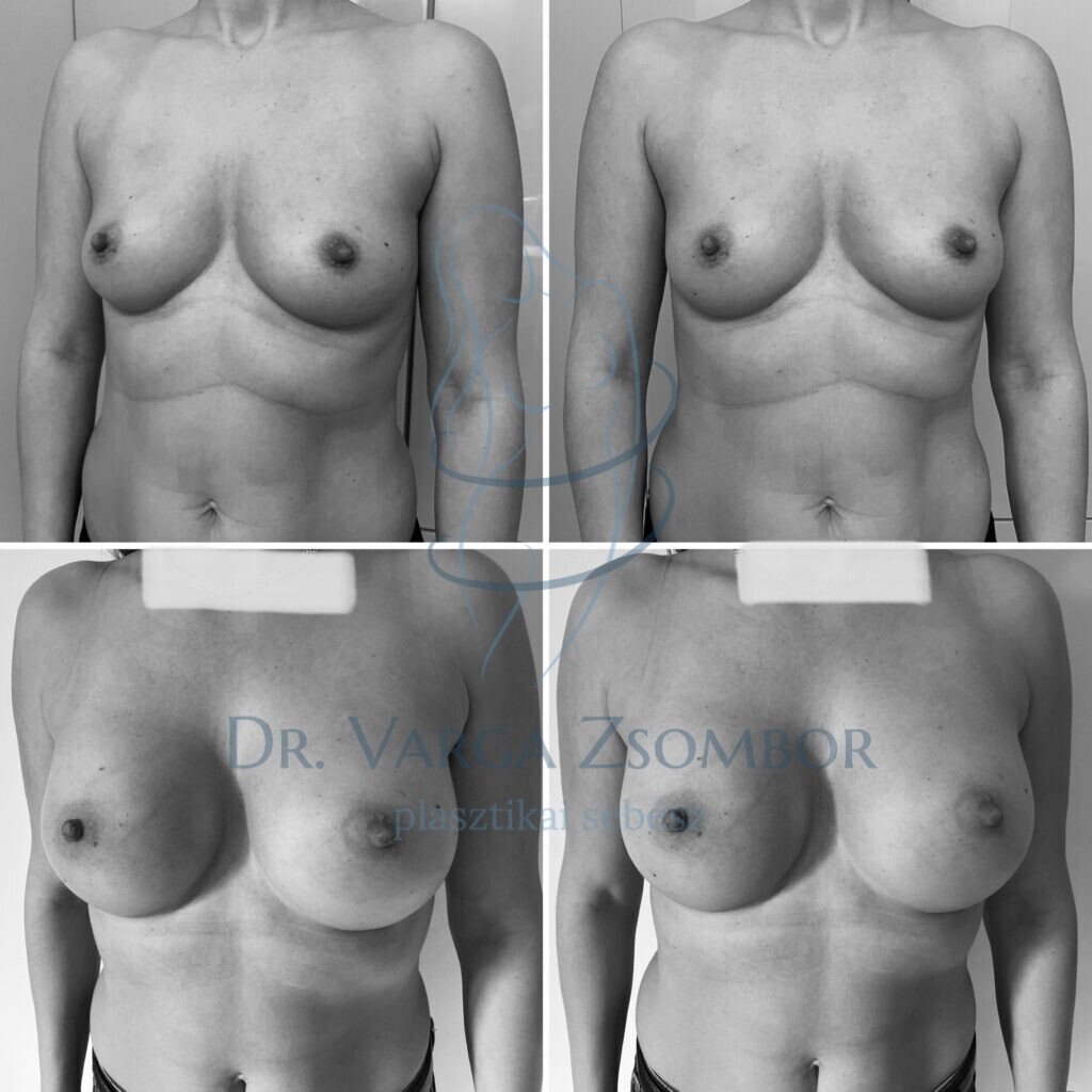 középmgasa mellimplantátum