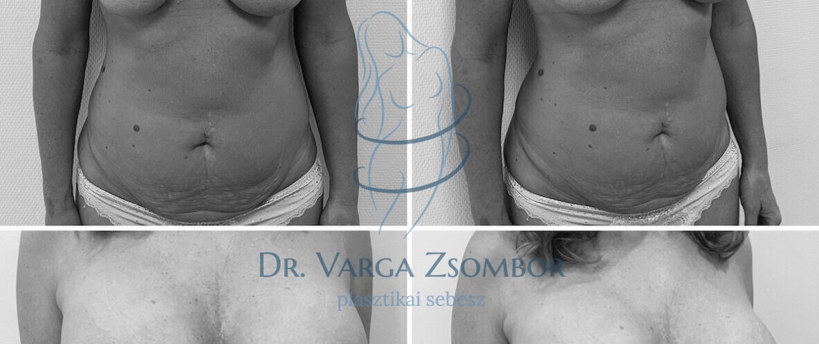 Mommy makeover előtte-utána