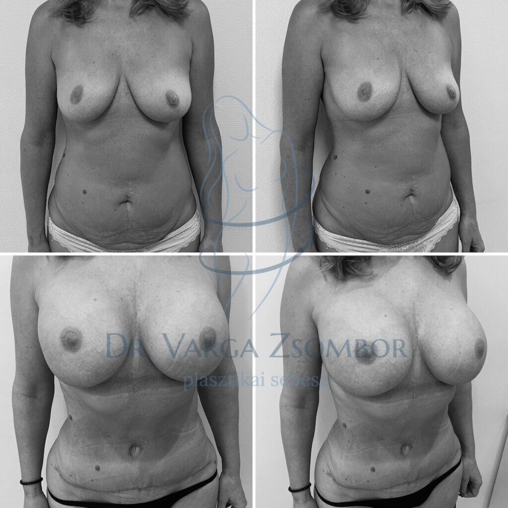 mommy makeover before after