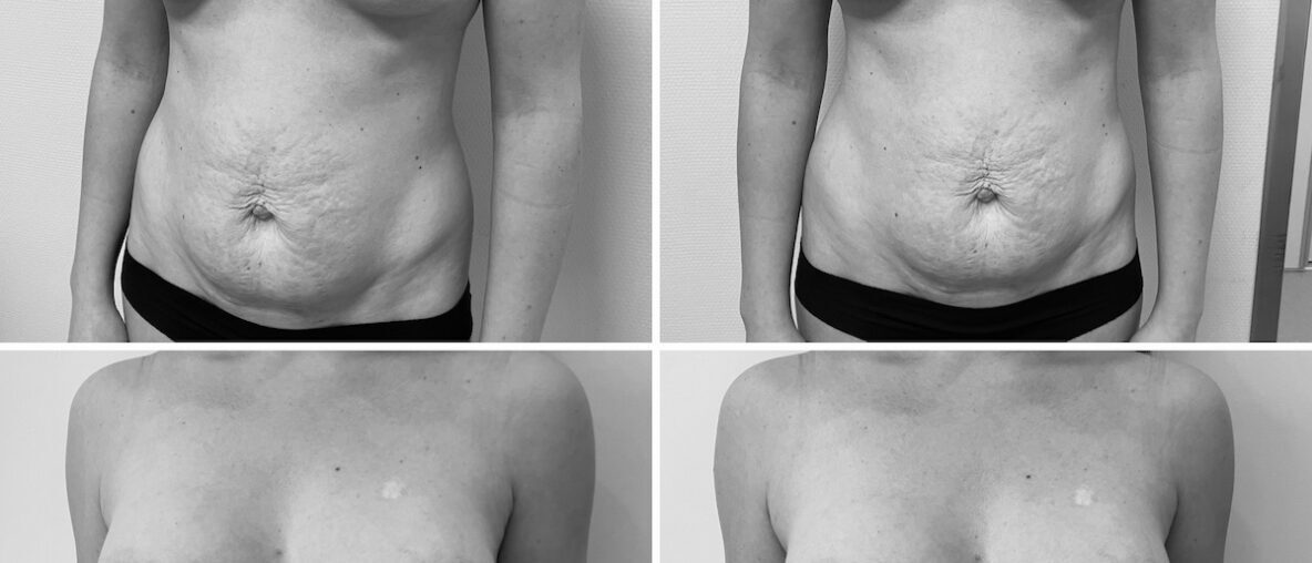 Mommy makeover után