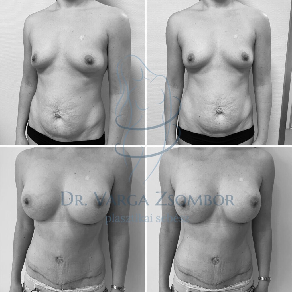 Mommy makeover után