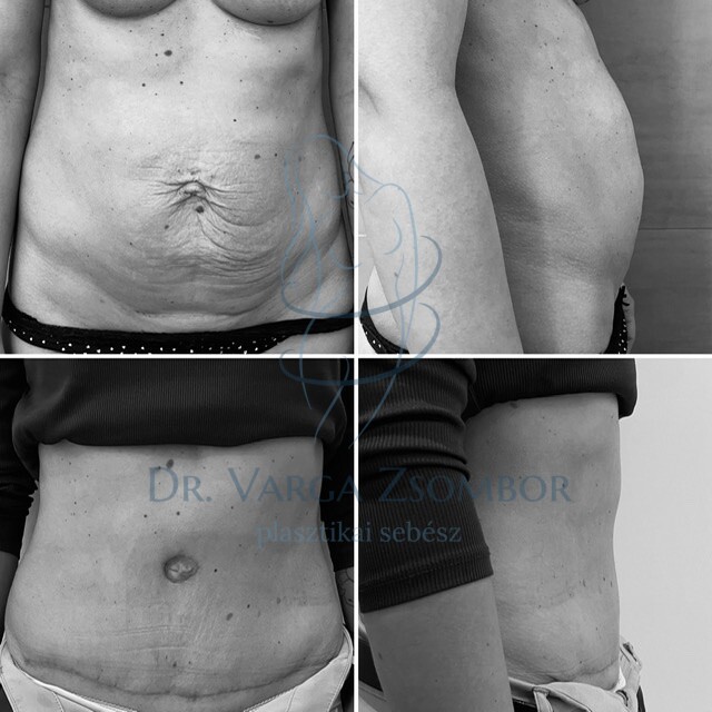 Teljes hasplasztika szétnyílt hasizom műtéti megoldása