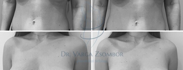 Mellfelvarrás előtt és után