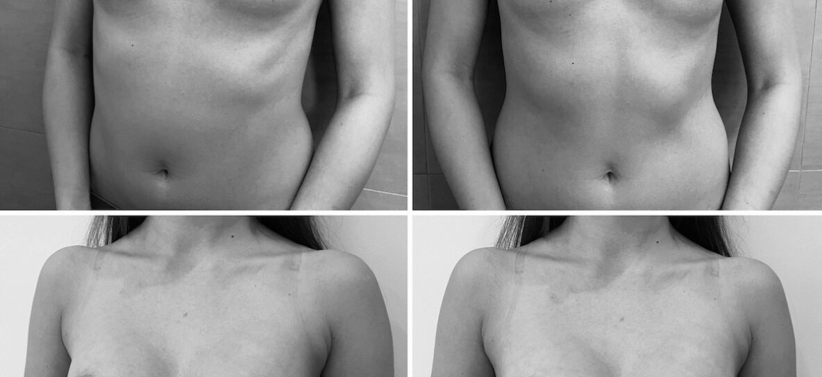 200 köbcentis (200cc) mellimplantátum