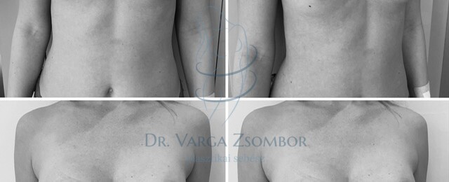 Mellaszimmetria plasztika