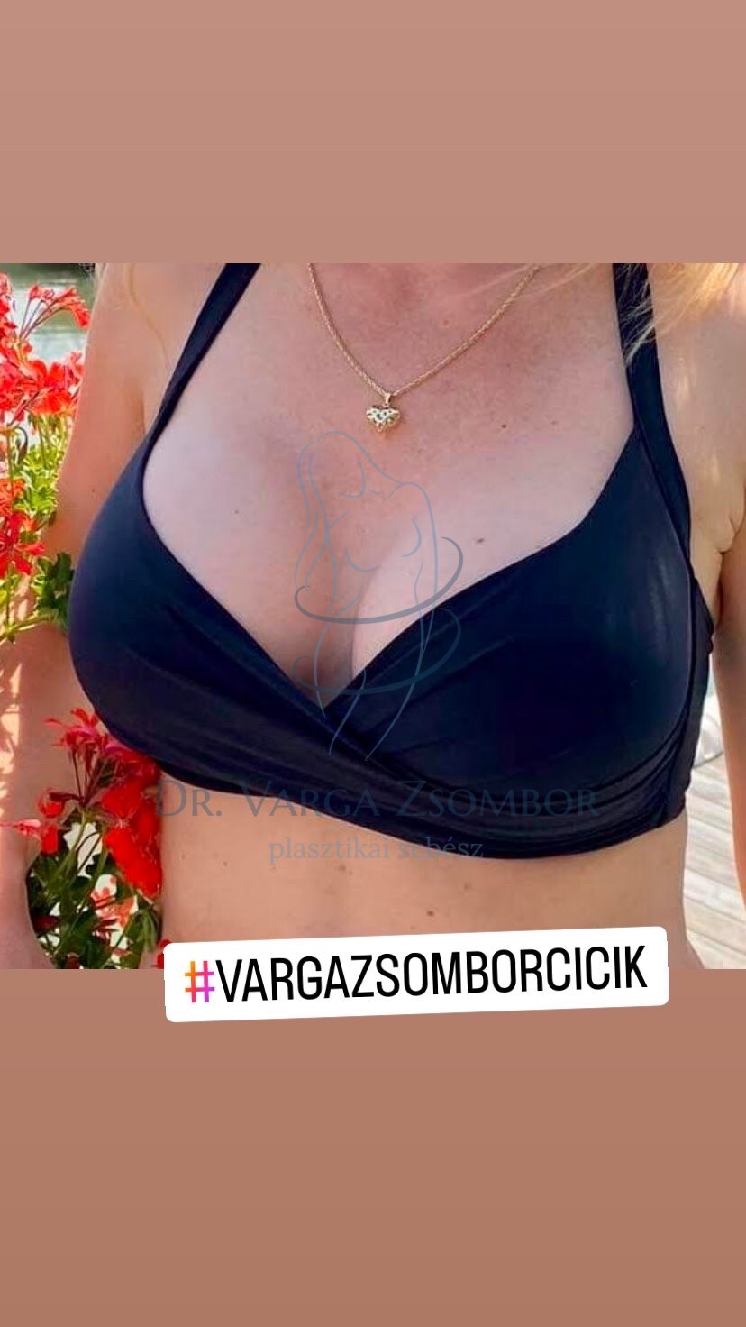 Mellplasztika - Dr. Varga Zsombor plasztikai sebész