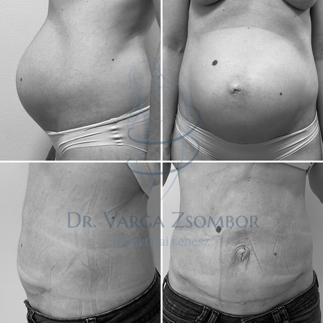 Hasplasztika szétnyílt hasizom köldöksérv