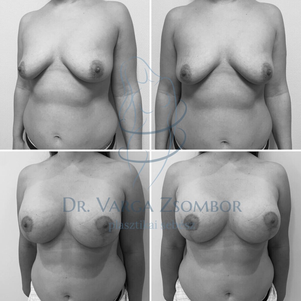 Mellfelvarrás implantátummal kombinálva