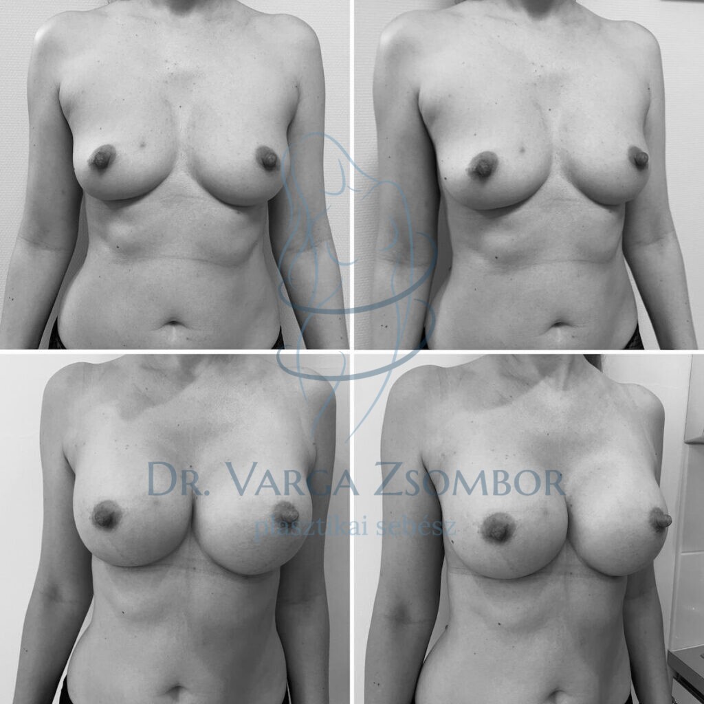 Mellnagyobbítás előtte-utána