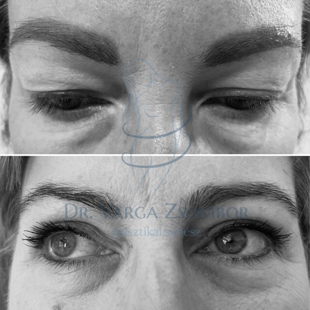 Felső szemhéjplasztika előtte-utána