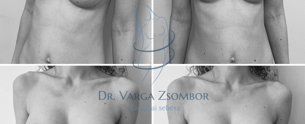 Nem egyforma a két mell