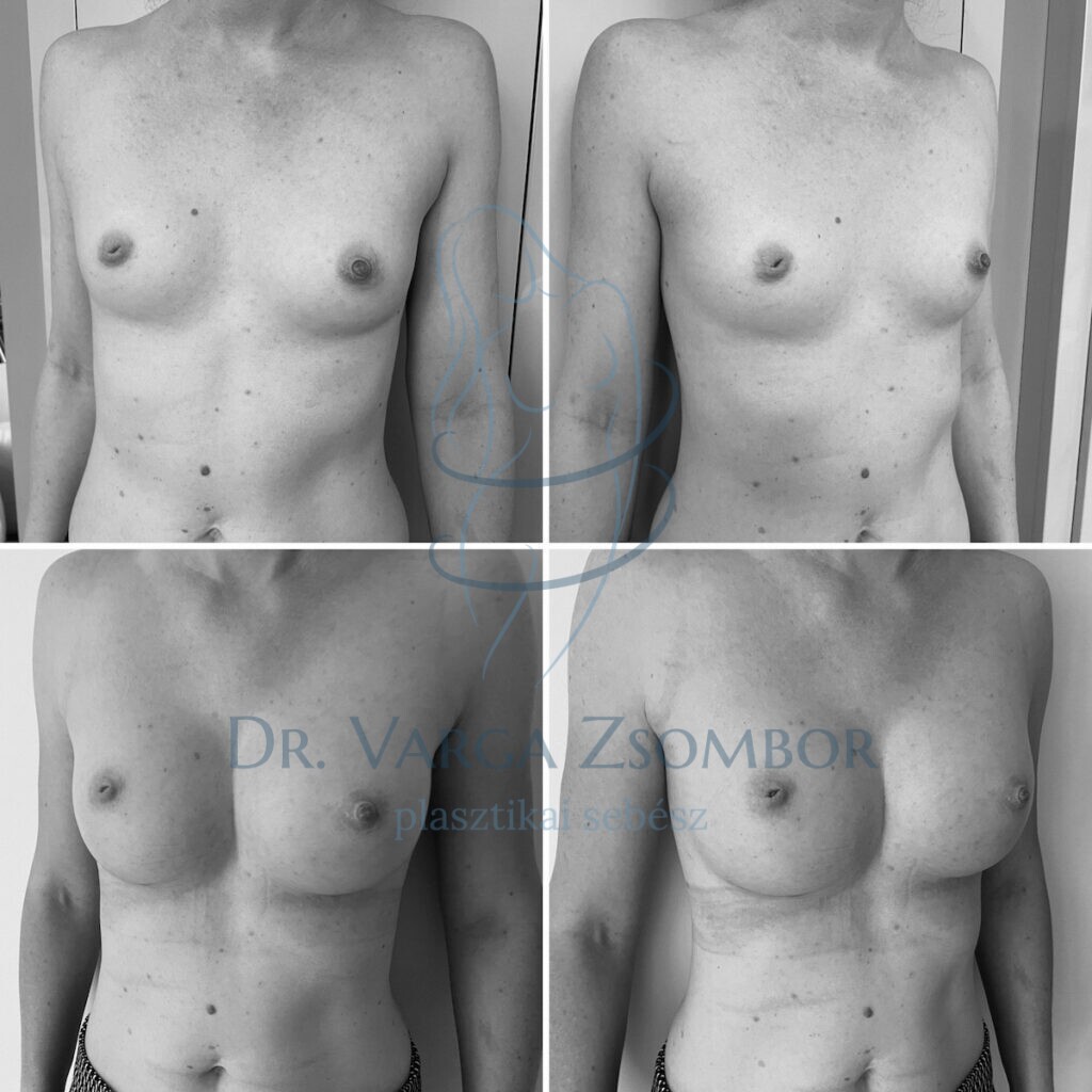 275cc mellimplantátum (előtte-utána)