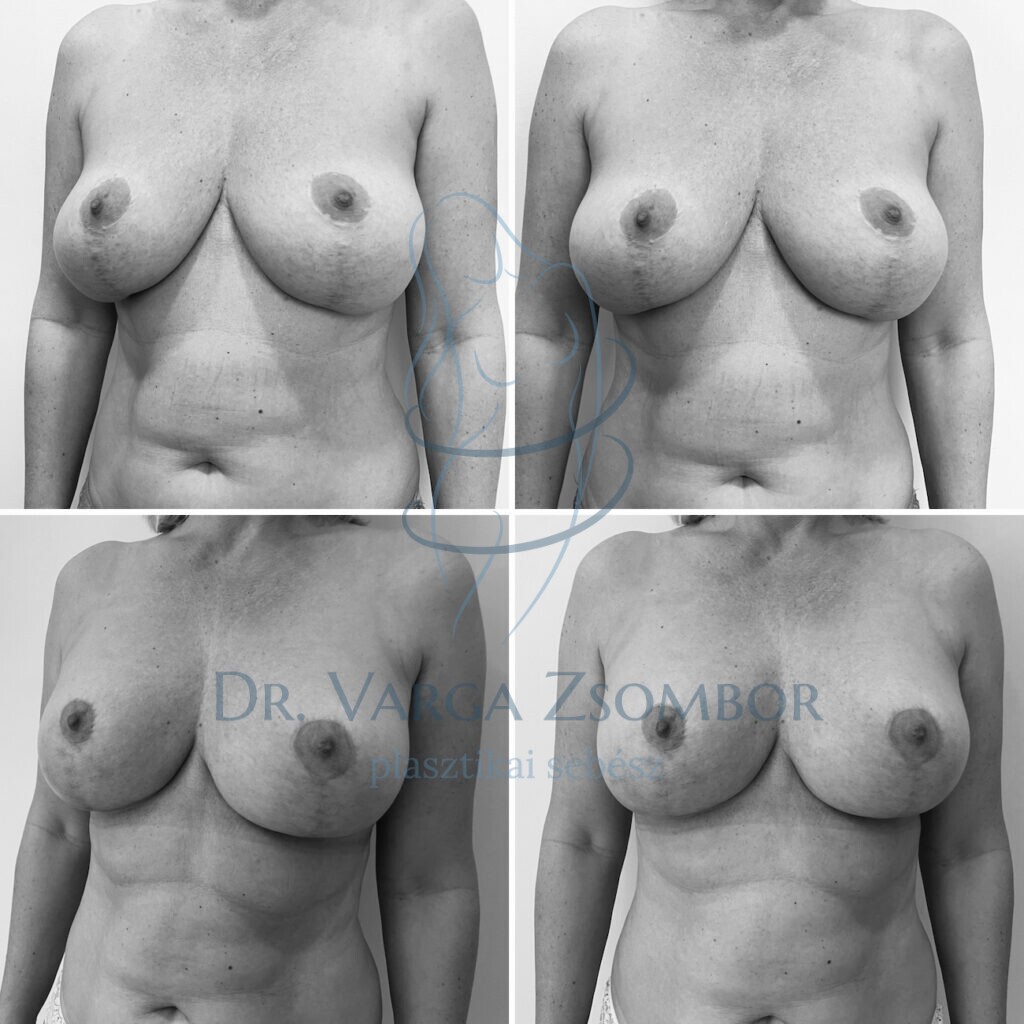 mellfelvarrás után