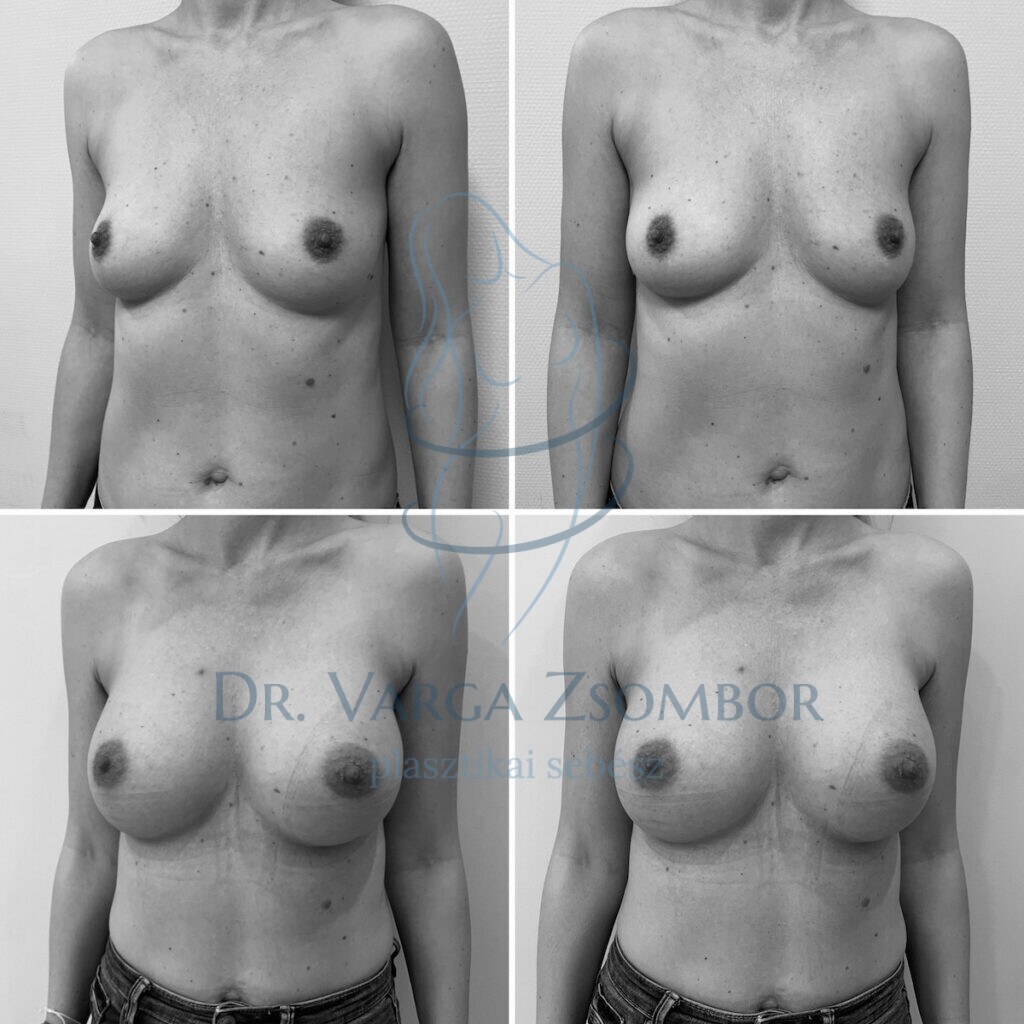 mellplasztika szülés és szoptatás után