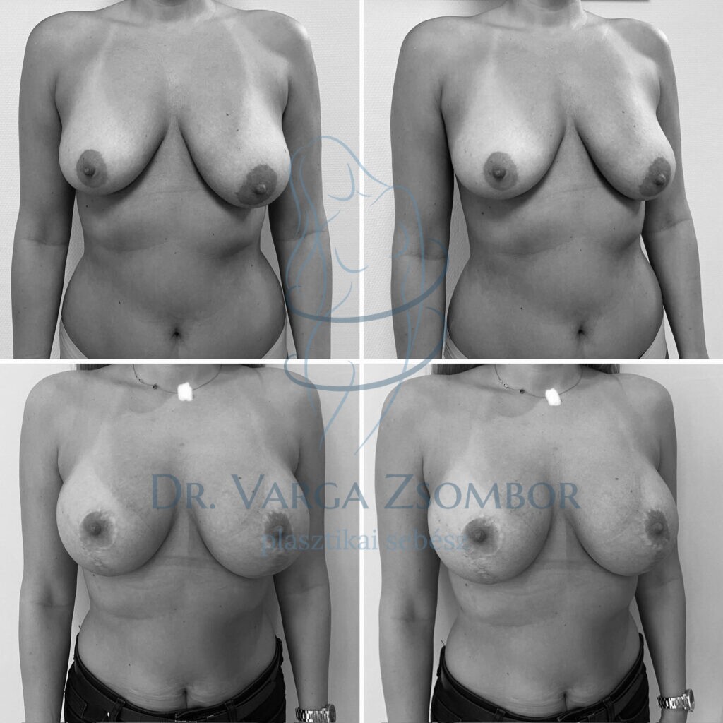 Mellfelvarrás és 325cc implantátum behelyezés