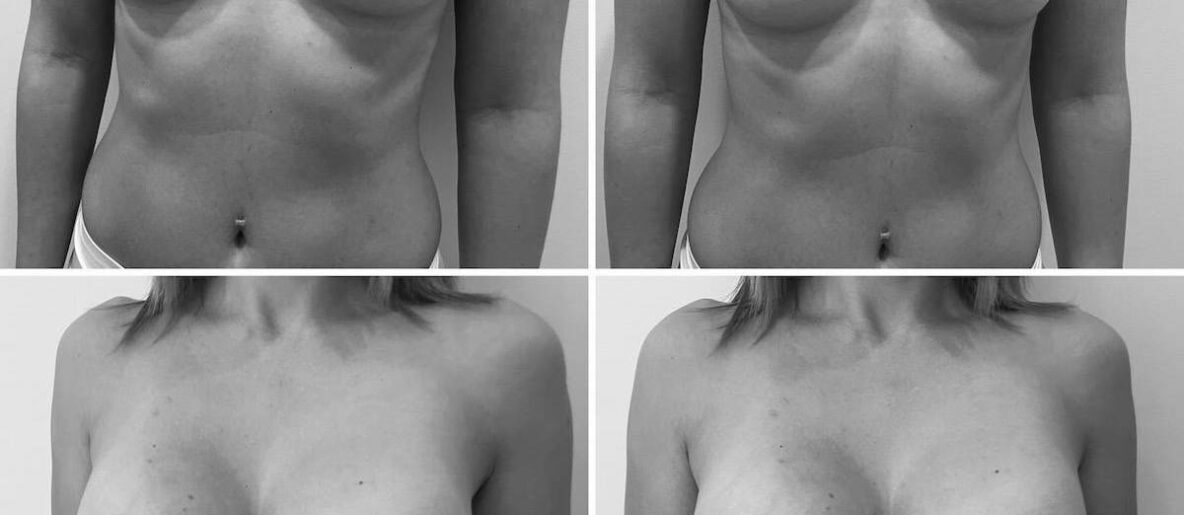 350cc mellimplantátum előtte-utána