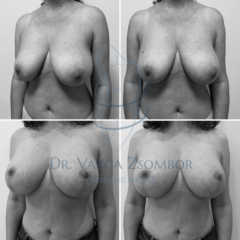 Mellkisebbítő műtét után